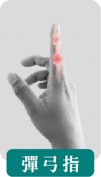 彈弓指（狹窄性腱鞘炎）示意圖